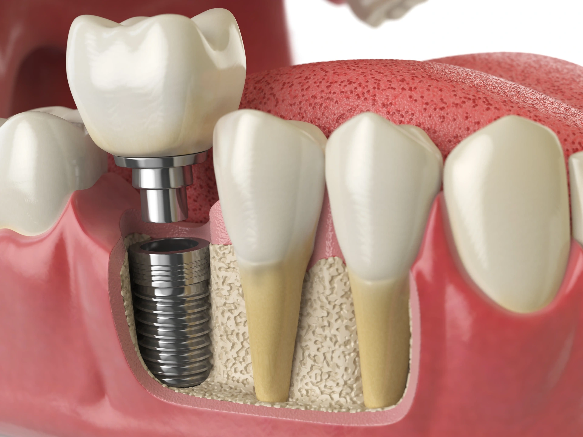 Dental implant anatomy