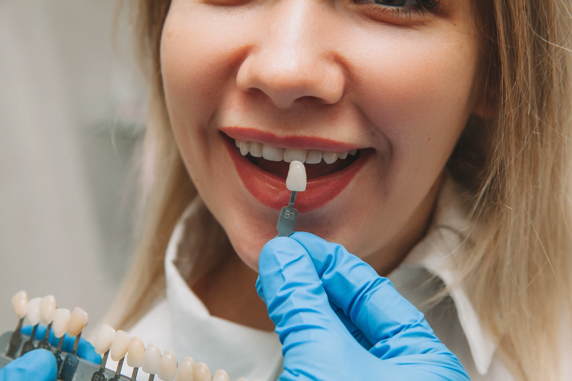 Smile makeover with veneers