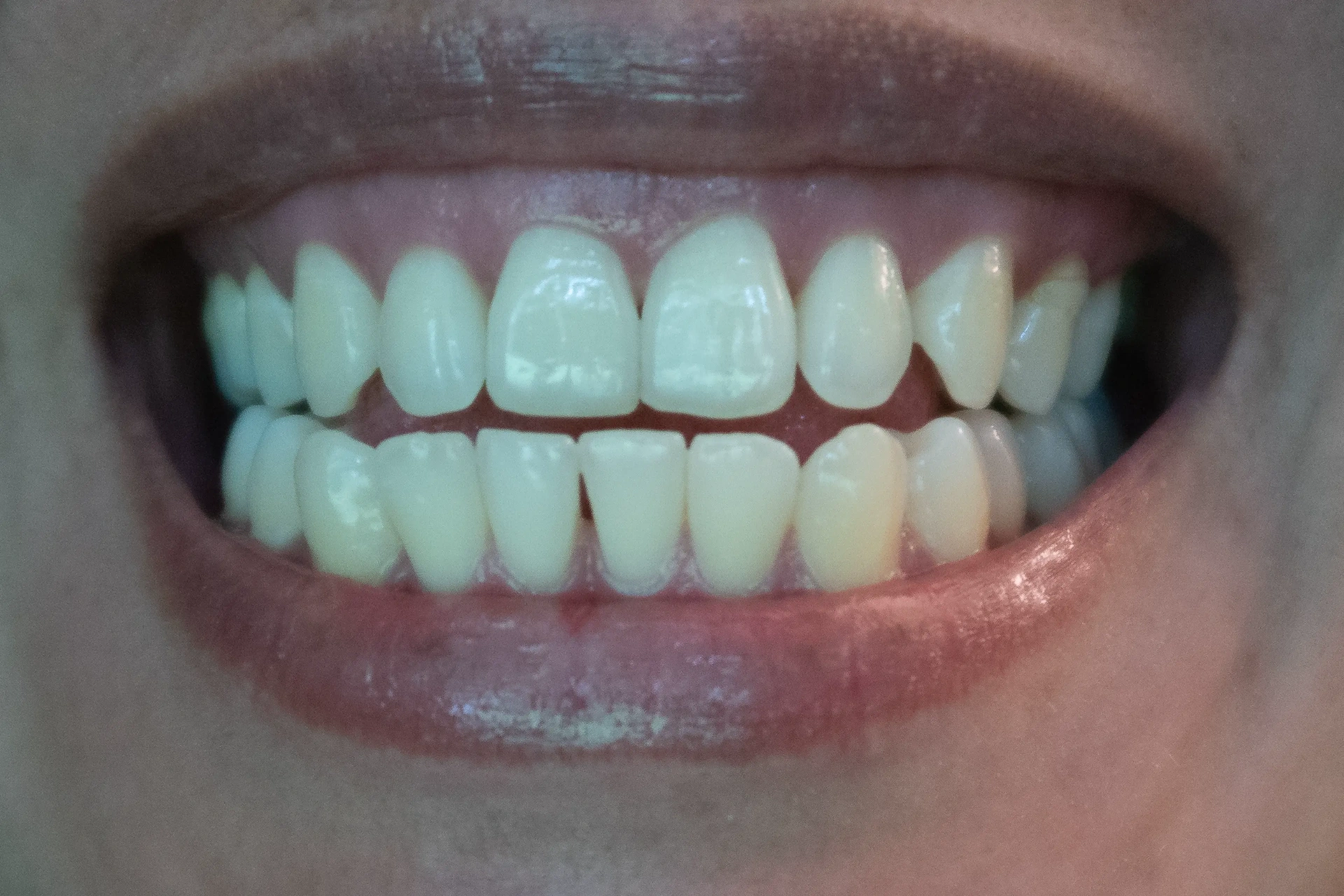 After Dental Implants Mississauga - Single tooth implant restoration