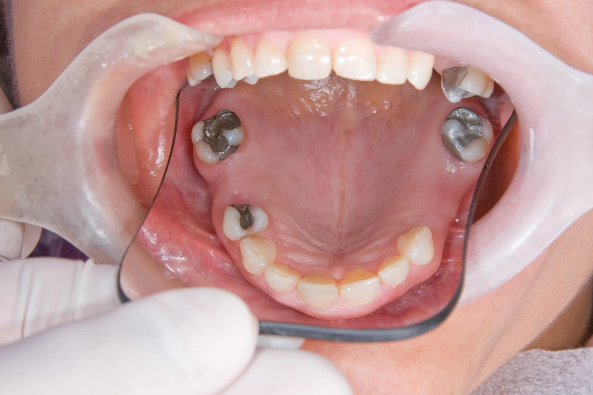 Before Dental Implants Mississauga - Multiple implant case