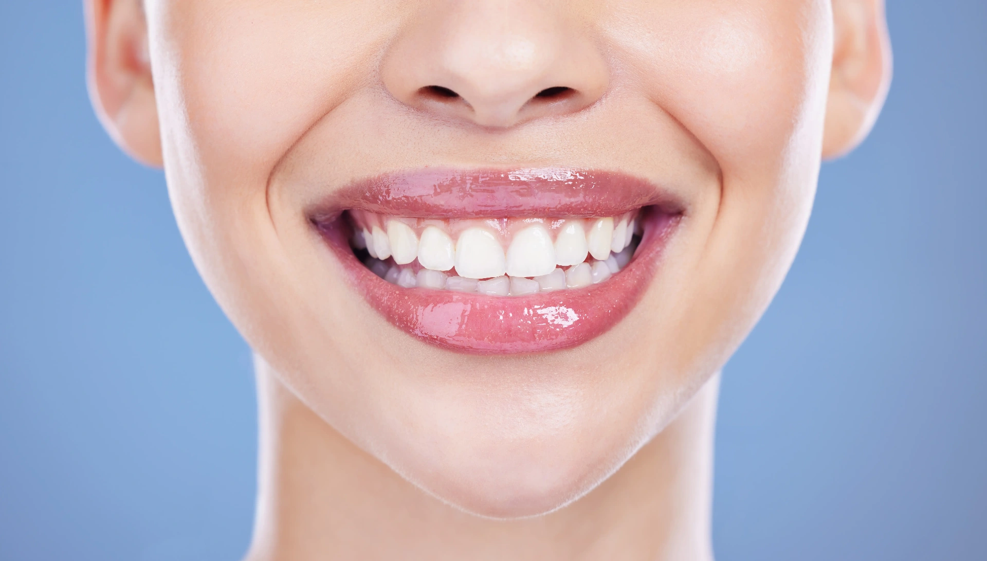 After Invisalign Clear Aligners Mississauga - Invisalign Treatment