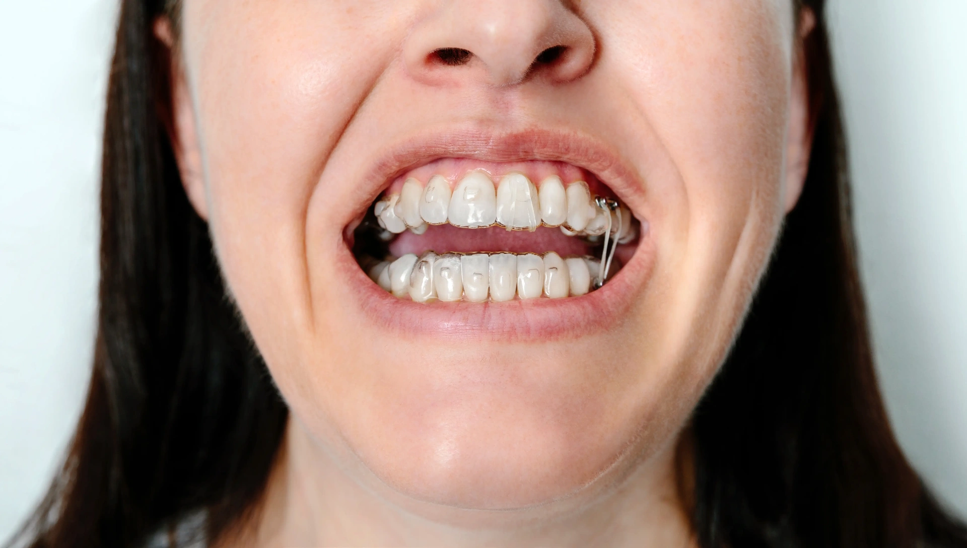 Before Invisalign Clear Aligners Mississauga - Invisalign Treatment