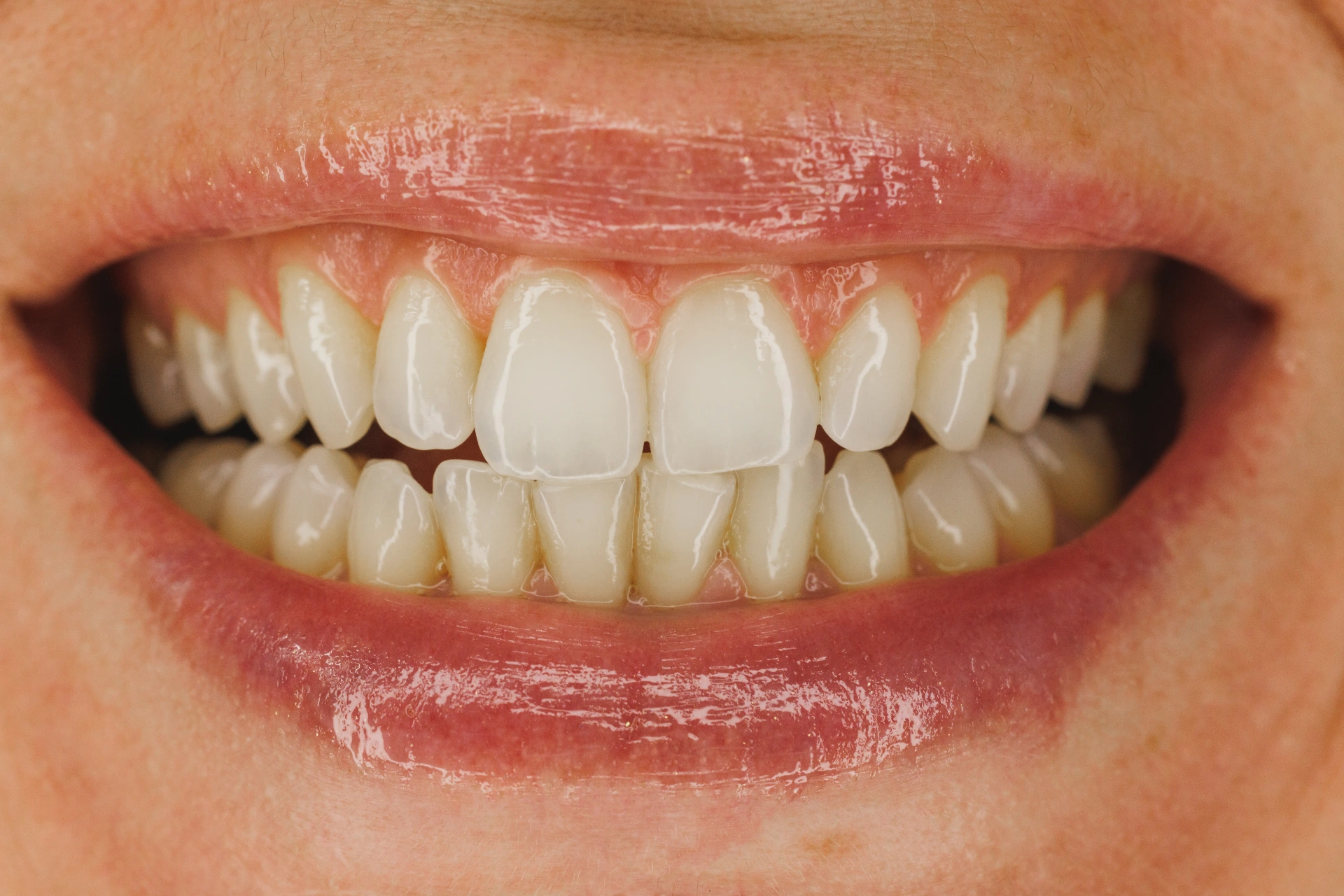After Periodontics / Gum Care Mississauga - Gum disease treatment results