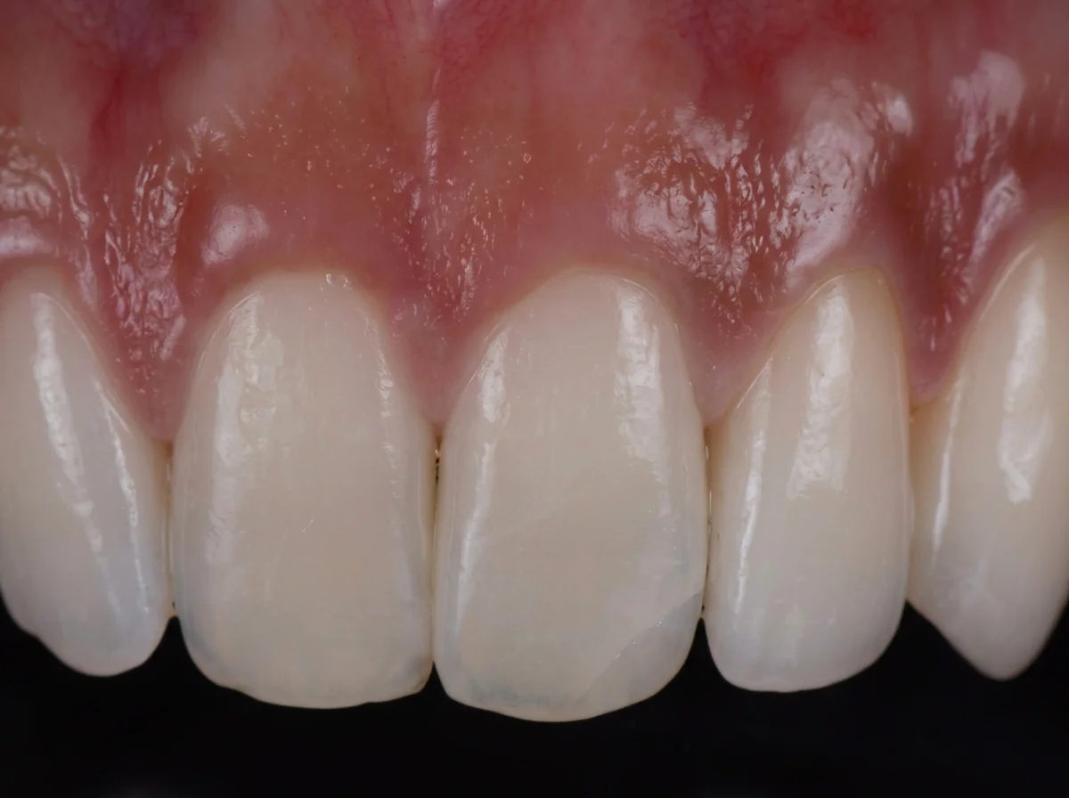 Resin Bonding — after treatment