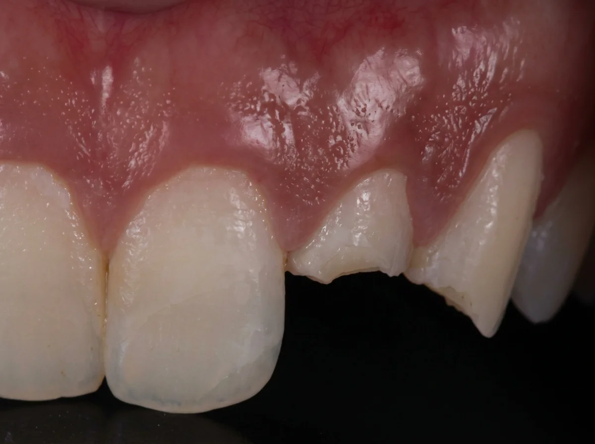 Resin Bonding — before treatment