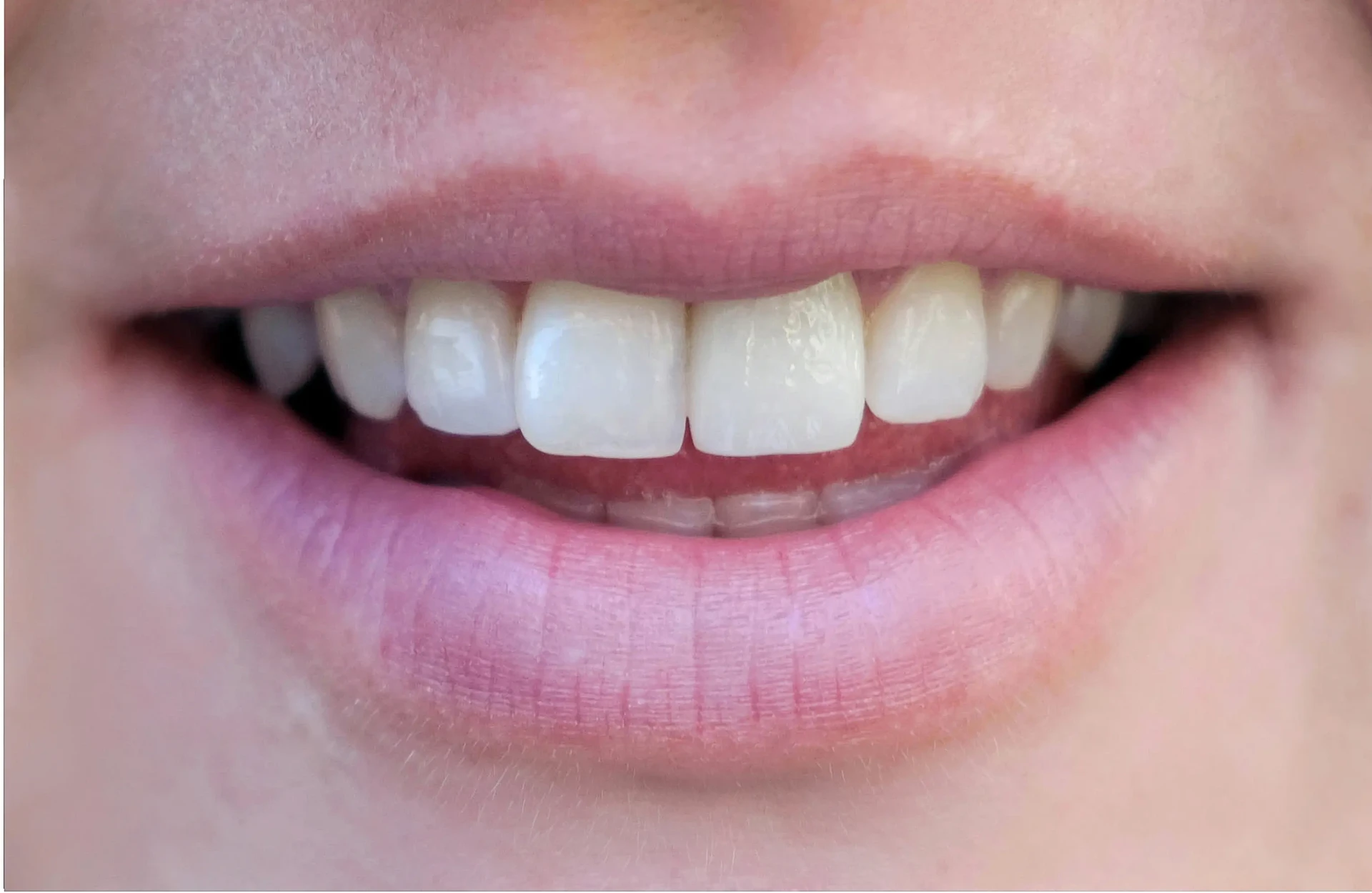 After Restorative Dental Care Mississauga - Crown restoration