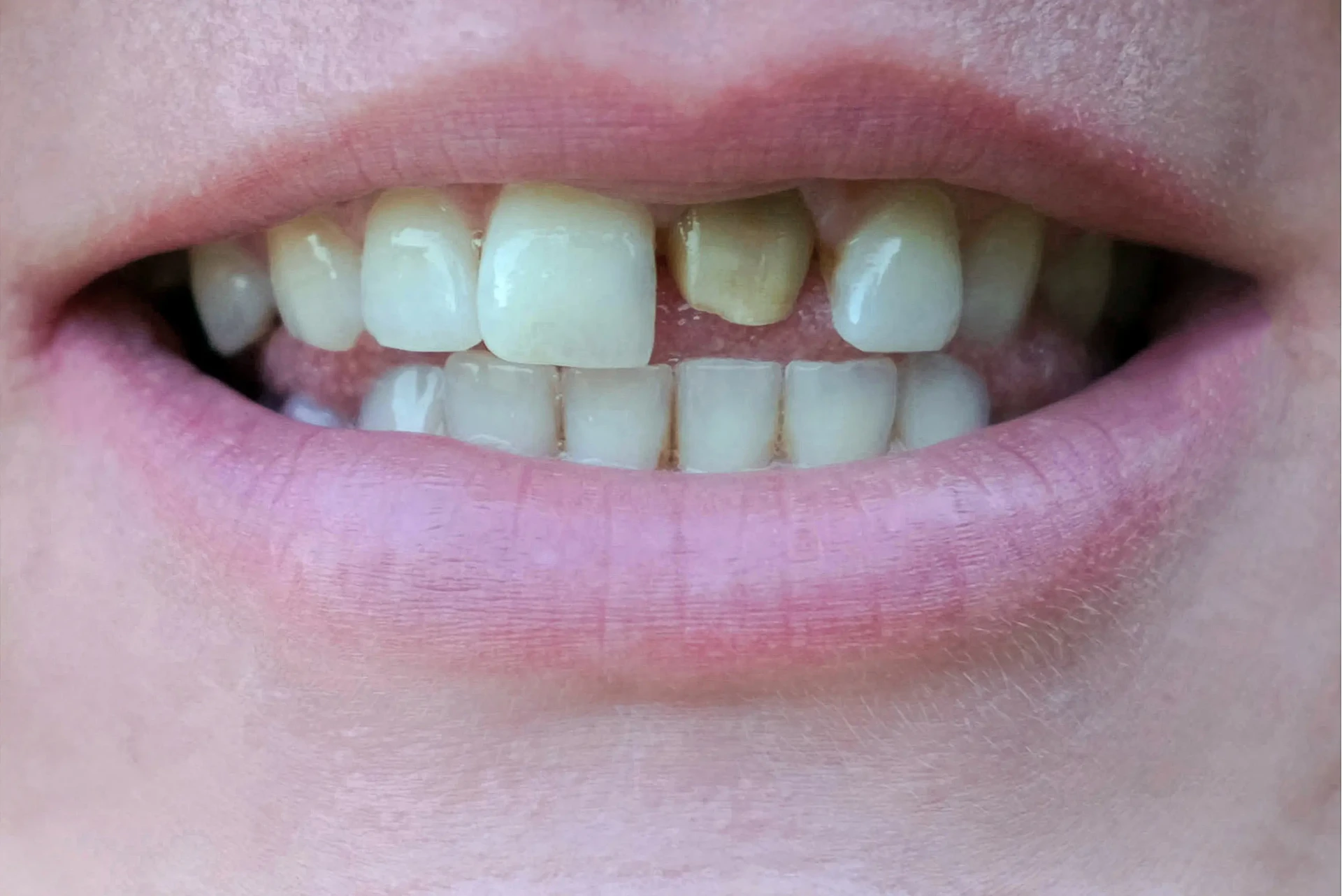 Before Restorative Dental Care Mississauga - Crown restoration
