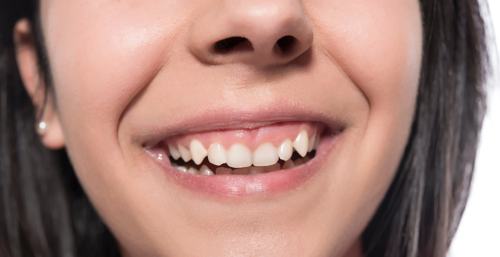 Before Laser Dentistry Mississauga - Gum reshaping with laser technology