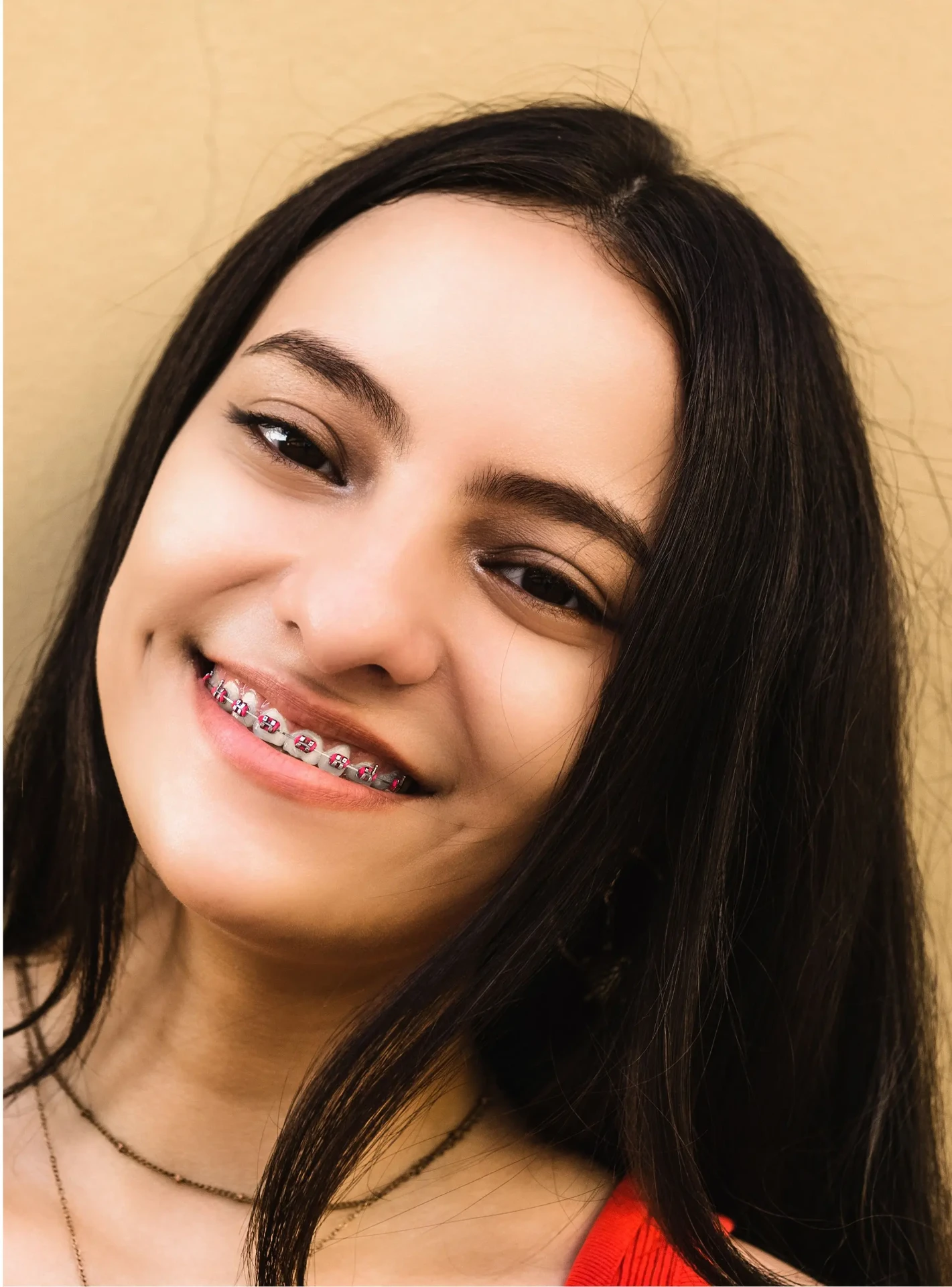 Before Orthodontics Mississauga - Teen braces transformation