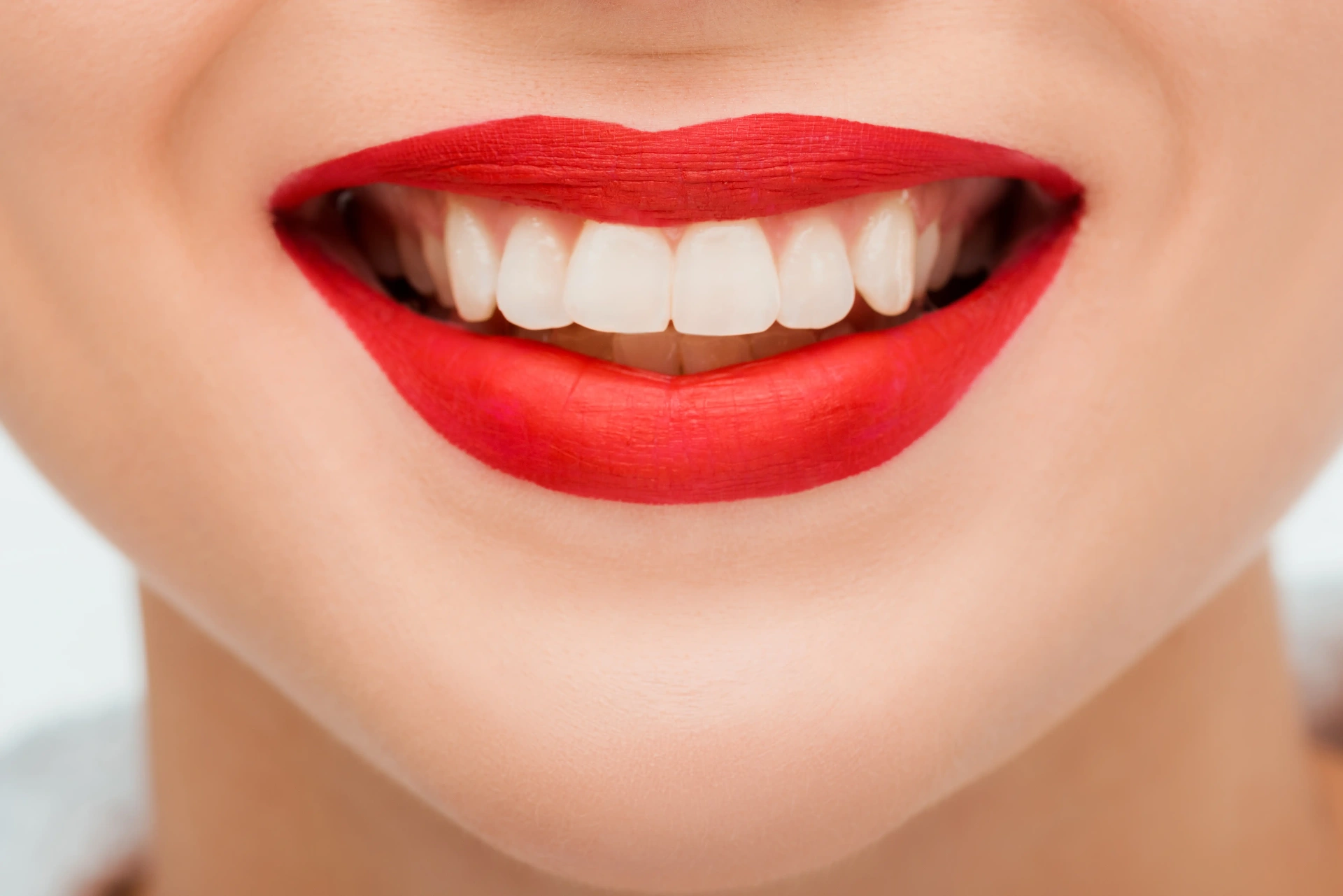 After Professional Teeth Whitening Mississauga - Professional whitening results